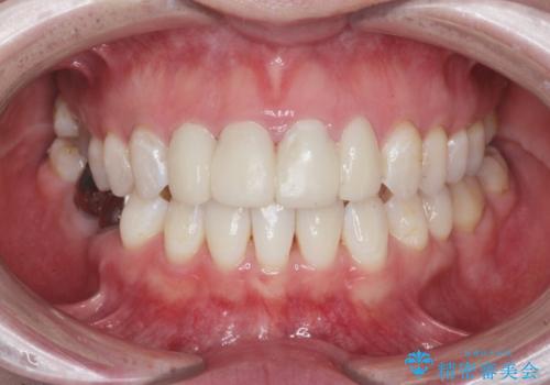 仮歯のまま放置していた前歯をセラミックにの治療前