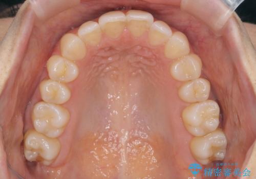 前歯のがたつきをしっかり治すマウスピース矯正の治療後