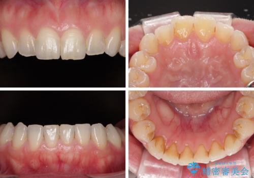 変色している歯をとにかく白く　全顎セラミック治療の治療前