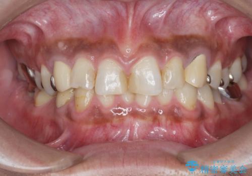[ セラミック治療 ]   虫歯でつぎはぎになってしまった歯をきれいにしたいの治療前
