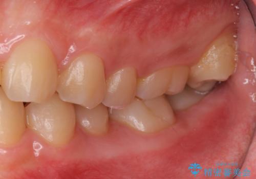 奥歯のかみ合わせも妥協しない　インビザライン治療の症例 治療前