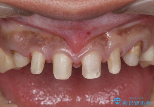 [ セラミック治療 ]   虫歯でつぎはぎになってしまった歯をきれいにしたいの治療中