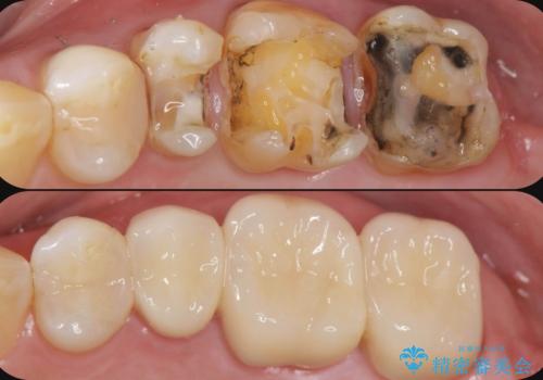 歯の神経を守る、精密な虫歯治療の実践