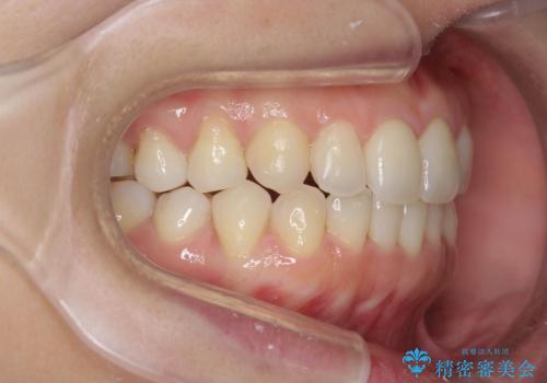[前歯のねじれ・がたつきを治したい ]ワイヤーとマウスピースの併用矯正治療の治療中