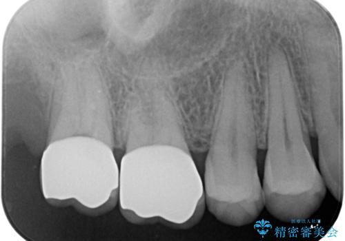 銀歯を白くしたいの治療後