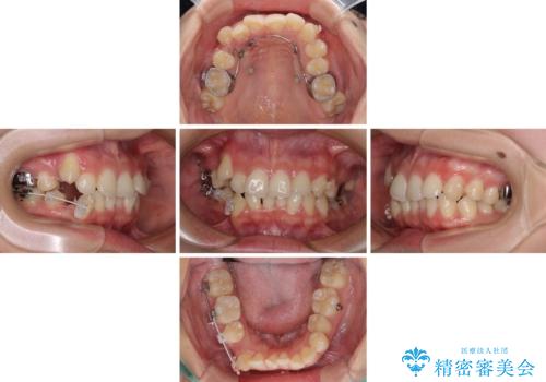 八重歯の抜歯矯正 補助装置とワイヤーを併用したインビザライン矯正治療の治療中