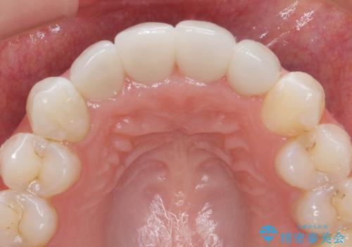 仮歯のまま放置していた前歯をセラミックにの治療後
