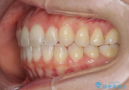 前歯のがたつきをしっかり治すマウスピース矯正の治療後