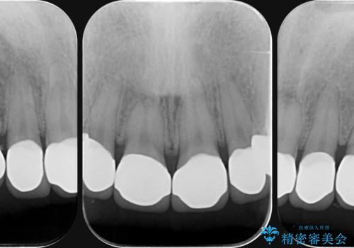 [ セラミック治療 ]   虫歯でつぎはぎになってしまった歯をきれいにしたいの治療後