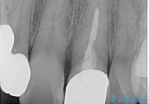 前歯を綺麗にしたい ジルコニアクラウンでの治療の治療前