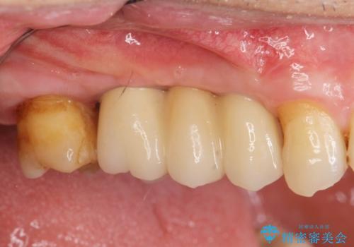 失った奥歯を、インプラント治療で機能回復の症例 治療後