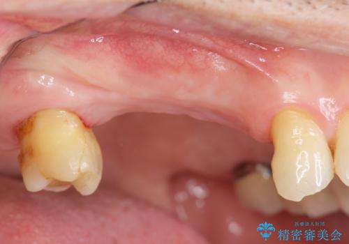 失った奥歯を、インプラント治療で機能回復の症例 治療前