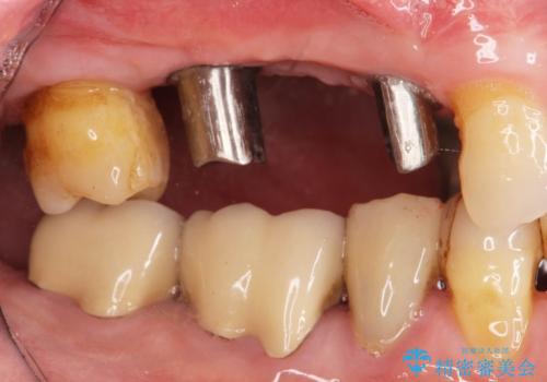 失った奥歯を、インプラント治療で機能回復の治療中