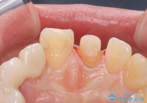 前歯を綺麗にしたい ジルコニアクラウンでの治療の治療中