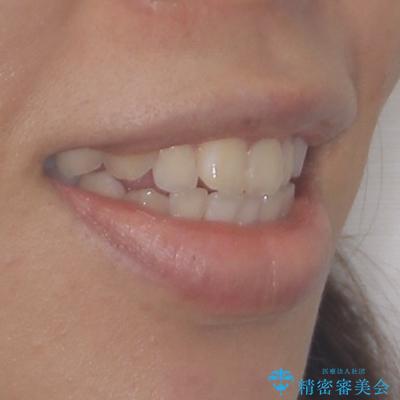 気がつくと唇が開く 口元を下げる抜歯矯正の治療前(顔貌)