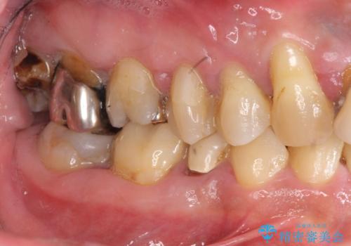 インプラント・ブリッジ補綴を含む、歯周病全顎治療の治療前