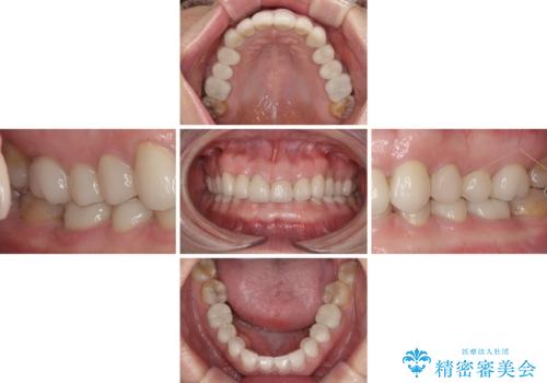 前歯の変色と隙間を治したい 前歯の審美歯科治療の治療後