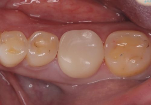 噛むと歯がズーンと鈍く痛むの症例 治療後