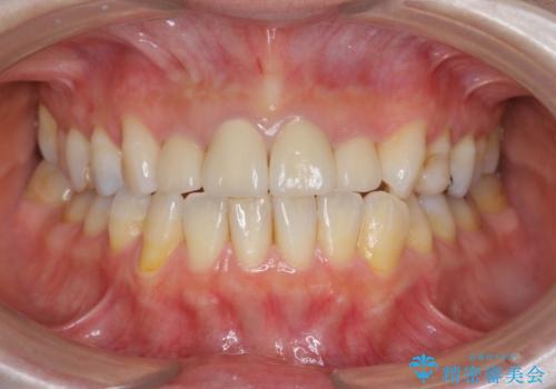 黒ずんだ見栄えの悪い前歯をきれいにしたいの治療後