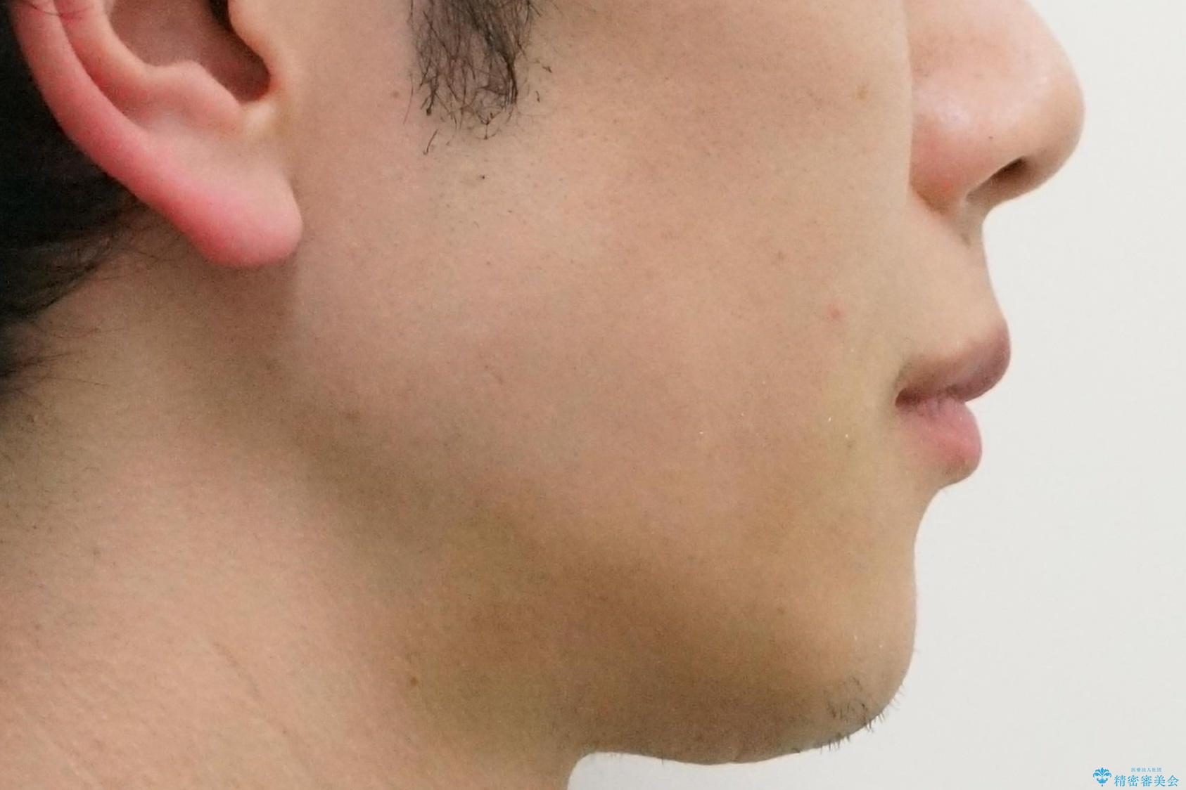 出っ歯をしっかり引っ込めたいの治療後(顔貌)