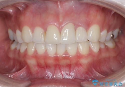 [ セラミック治療 ]  前歯の変色をきれいにしたいの治療後