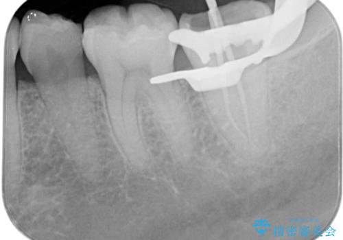 樋状根(といじょうこん)の根管治療の治療中