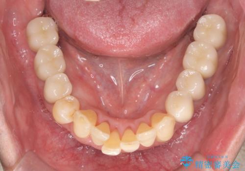 インプラント・ブリッジ補綴を含む、歯周病全顎治療の治療後