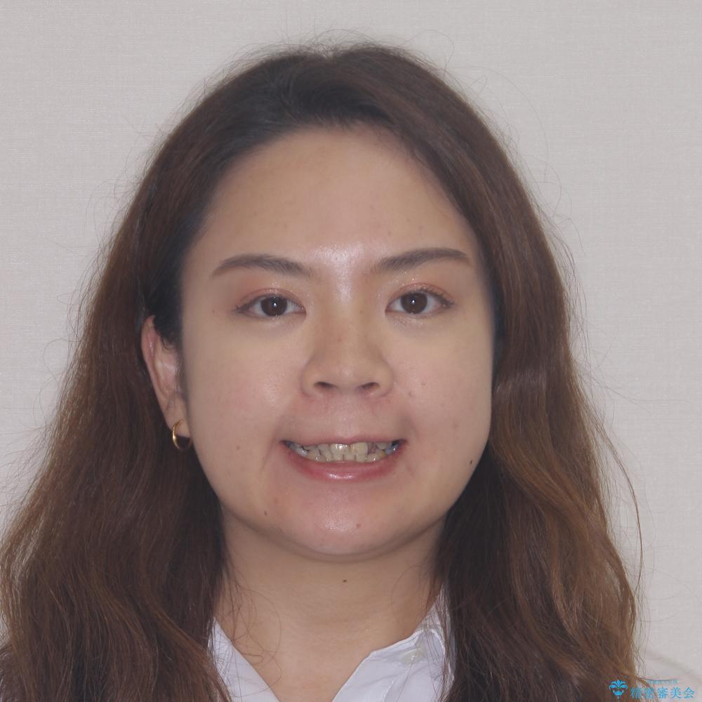 【モニター】上下の八重歯を治したい ワイヤー装置による矯正治療の治療前(顔貌)