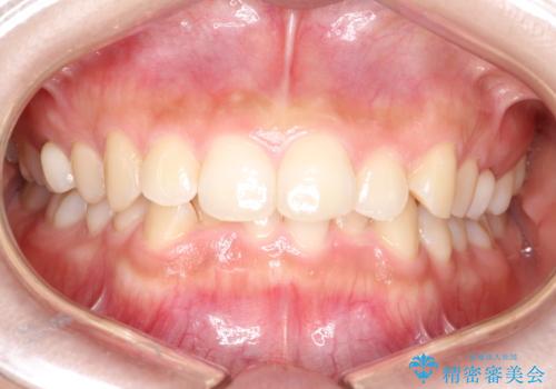 【ワイヤー矯正】前歯のがたがたをなおしたいの治療前