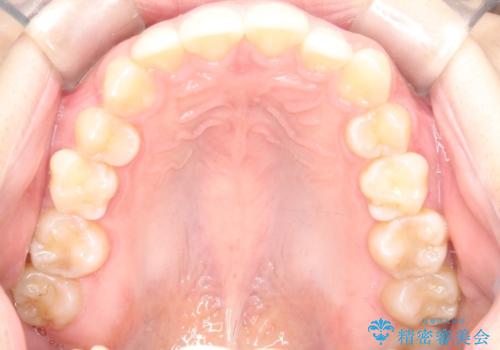【ワイヤー矯正】前歯のがたがたをなおしたいの治療前