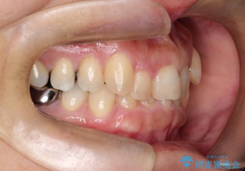 【インビザライン】重度叢生をなおしたいの治療前