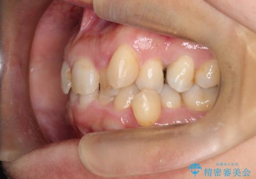 【インビザライン】重度叢生をなおしたいの治療前