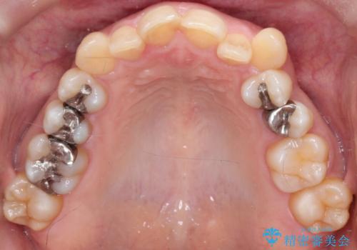 【インビザライン】重度叢生をなおしたいの治療前