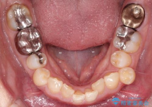 【インビザライン】重度叢生をなおしたいの治療前