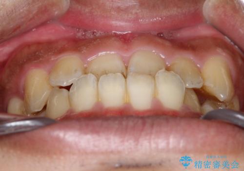 【インビザライン】反対咬合をなおしたいの治療前