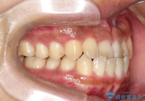 【インビザライン】反対咬合をなおしたいの治療前