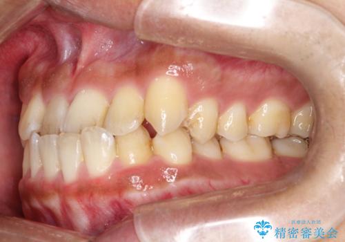 【インビザライン】反対咬合をなおしたいの治療前