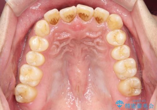 【インビザライン】反対咬合をなおしたいの治療前