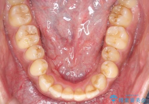 【インビザライン】反対咬合をなおしたいの治療前