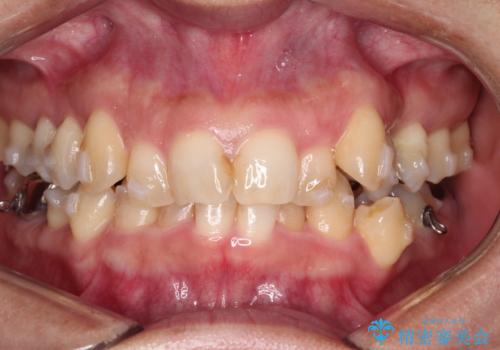 【インビザライン】重度叢生をなおしたいの治療中
