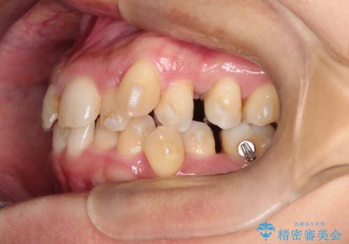 【インビザライン】重度叢生をなおしたいの治療中