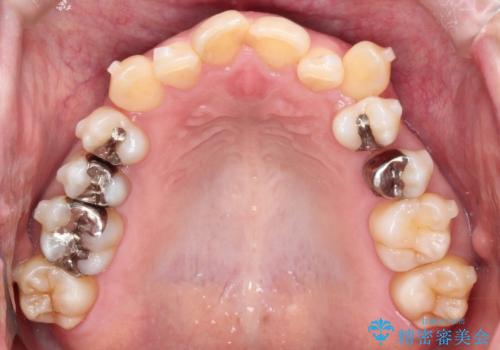 【インビザライン】重度叢生をなおしたいの治療中
