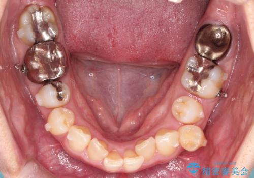 【インビザライン】重度叢生をなおしたいの治療中