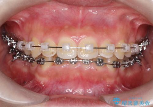 【ワイヤー矯正】前歯のがたがたをなおしたいの治療中