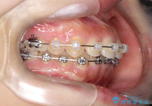 【ワイヤー矯正】前歯のがたがたをなおしたいの治療中