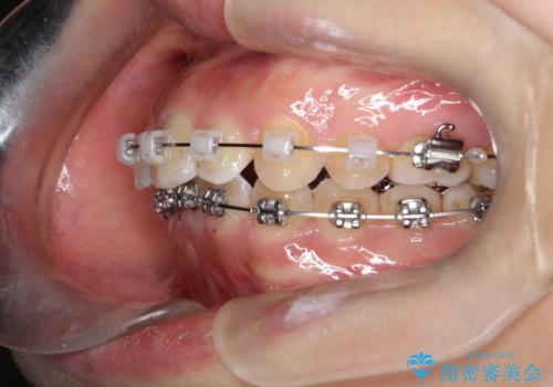 【ワイヤー矯正】前歯のがたがたをなおしたいの治療中