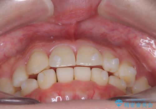 【インビザライン】八重歯が気になるの治療中