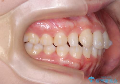 【インビザライン】八重歯が気になるの治療中