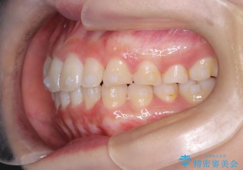【インビザライン】八重歯が気になるの治療中