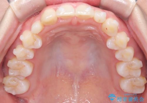 【インビザライン】八重歯が気になるの治療中